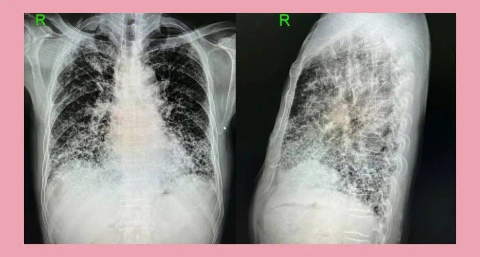 肺CT提示：肺轻度间质性改变是什么意思？该怎么办？