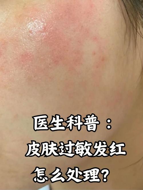 皮肤过敏红肿怎么办