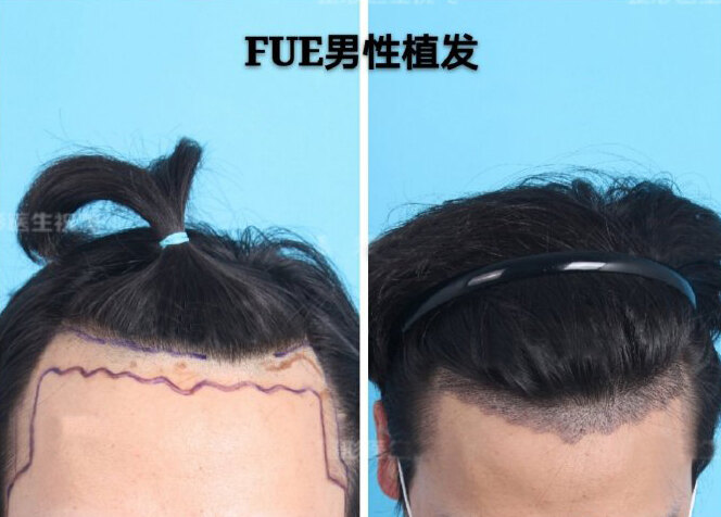 发际线美学丨什么样的发际线才是适合自己的？