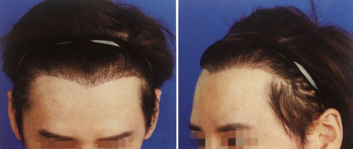 发际线美学丨什么样的发际线才是适合自己的？