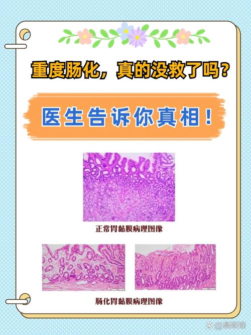 胃中度肠化是什么意思严重吗