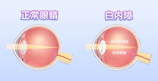 暖心守护！永春爱尔眼科医院为孤寡驼背老人重铸清晰视界