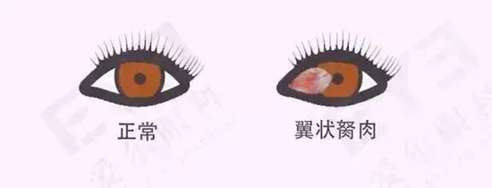 暖心守护！永春爱尔眼科医院为孤寡驼背老人重铸清晰视界