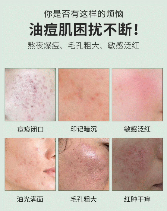 什么牌子的祛痘产品效果最好，青春痘怎样快速消除 - 哔哩哔哩