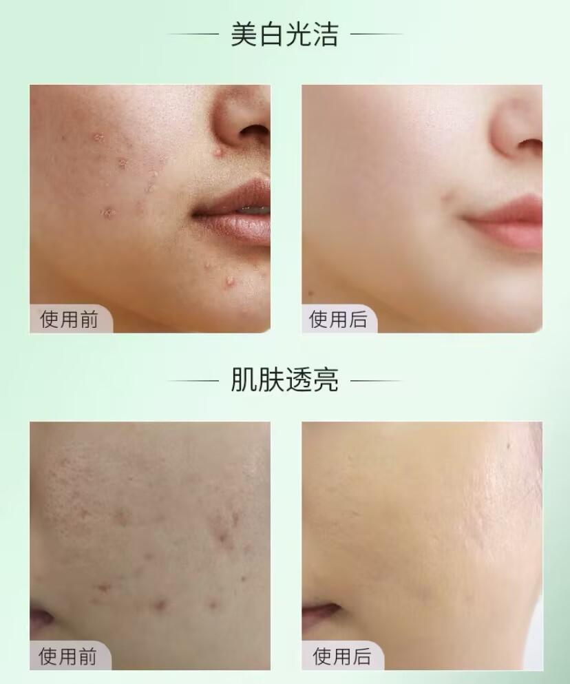 什么牌子的祛痘产品效果最好，青春痘怎样快速消除 - 哔哩哔哩