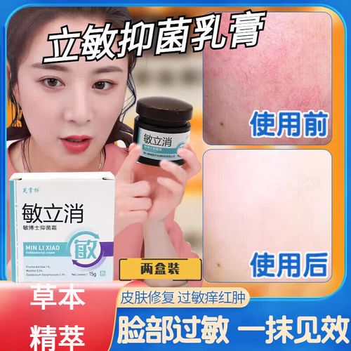 脸部过敏发红怎么退红用什么药膏