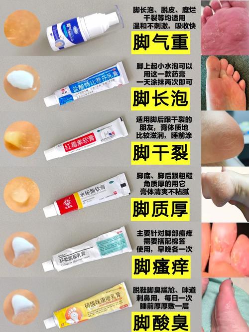 脚气如何治疗