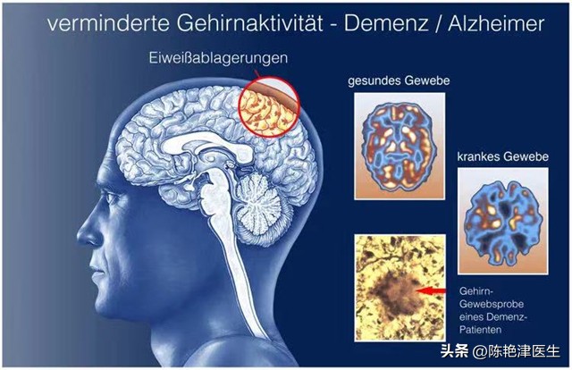 每吃一次，大脑萎缩就快一步？这5种食物是大脑老化的“加速器”