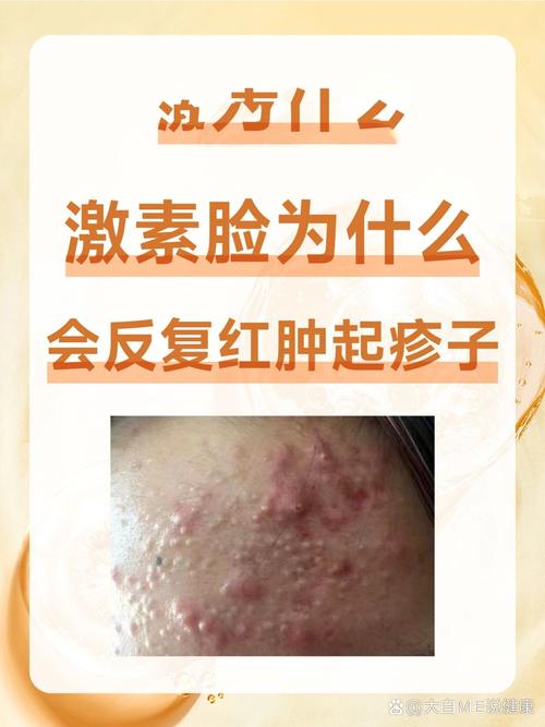 月经来时脸上发疹，对症治疗可以根治