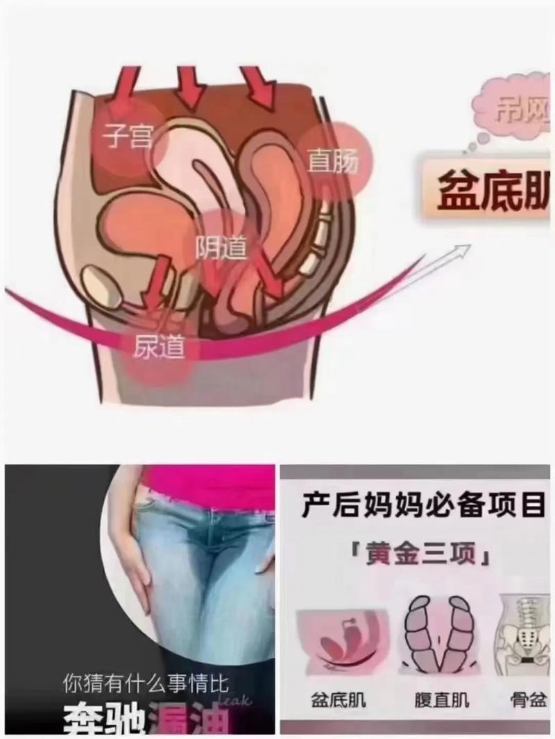 尿失禁——产后女性的“社交癌”