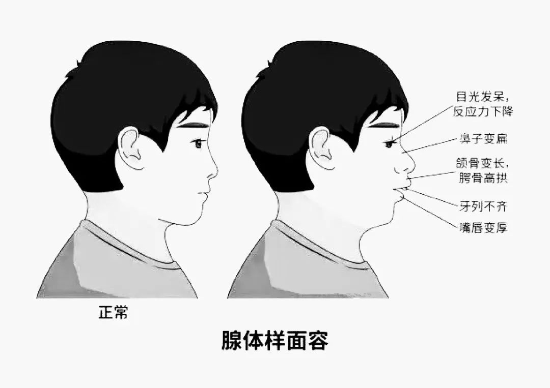 什么是耳鼻喉结构异常？一定要手术处理吗？【苏州做耳鼻喉手术的医院】