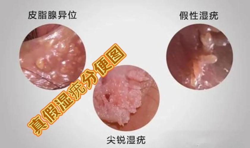 教你假性湿疣和尖锐湿疣的鉴别-图文并茂