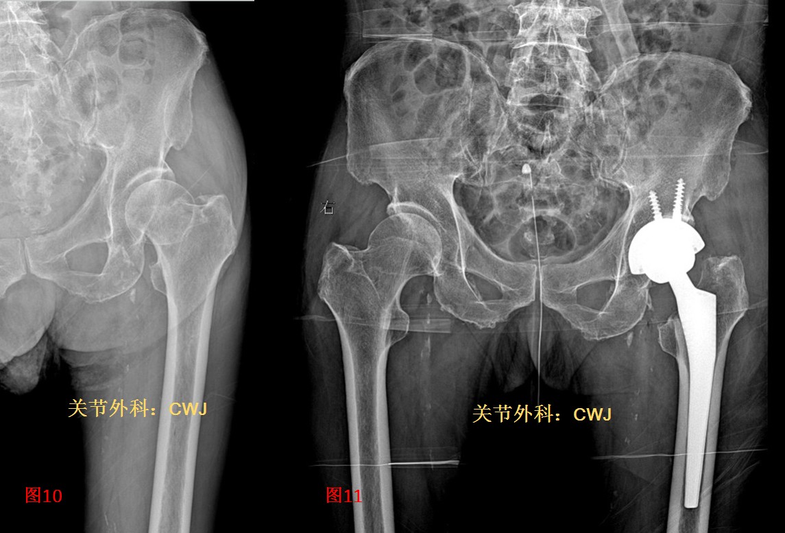 高龄股骨颈骨折关节置换手术风险大吗？该如何面对做出选择？