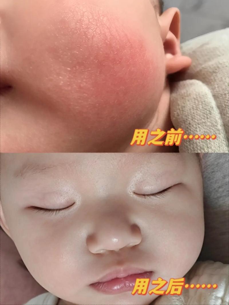 周岁宝宝冬天脸皲得厉害该怎么办