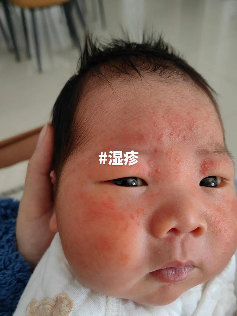 新生儿湿疹能自己好吗