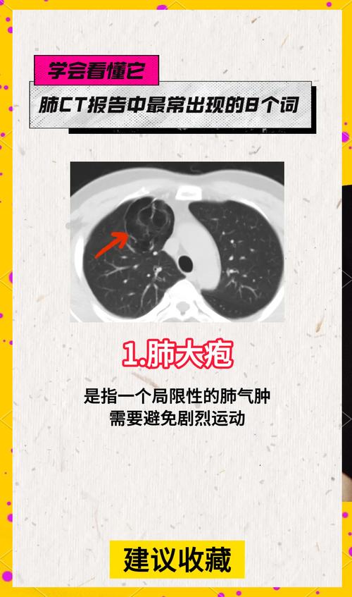 看CT片一头雾水，分不清肺结核与肺癌？看了这篇文章你就懂了