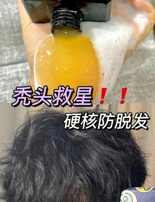 男性防脱发，6个方法可缓解