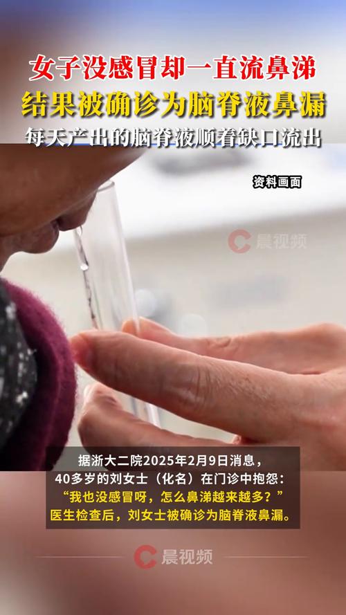 男子清水鼻涕流不停 竟是脑脊液鼻漏