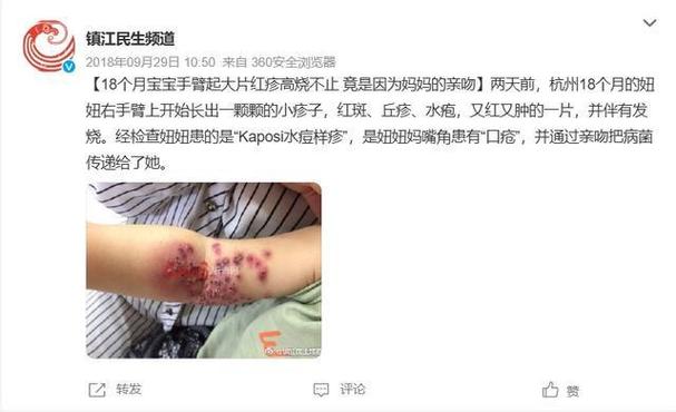 可怕！被陌生人拥抱亲吻，刚满月宝宝眼部发疱疹险失明