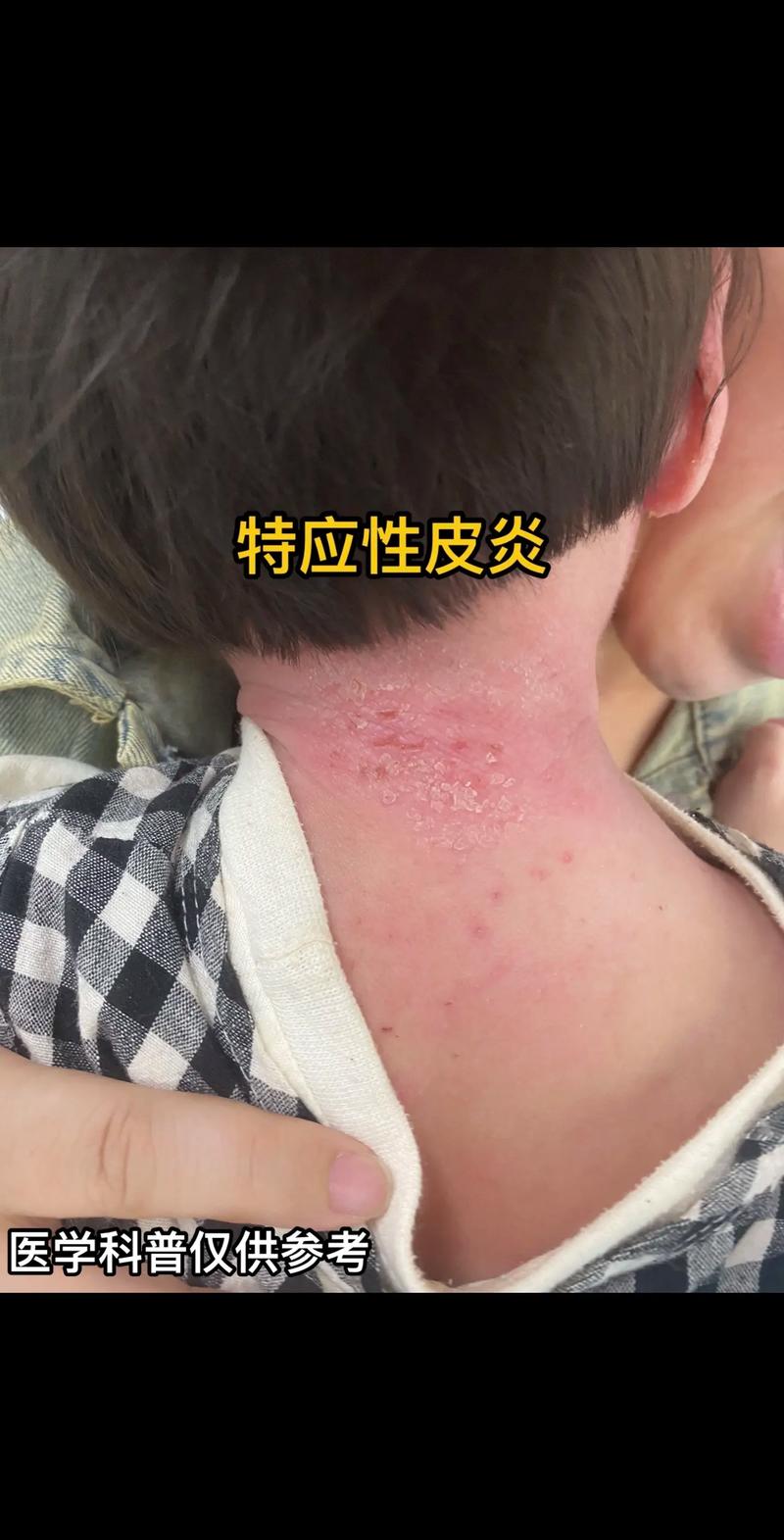 世界上最昂贵的皮肤病——特应性皮炎的福音来了
