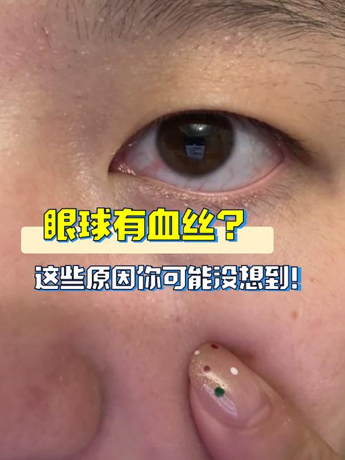 宝宝眼睛有血丝该怎么办