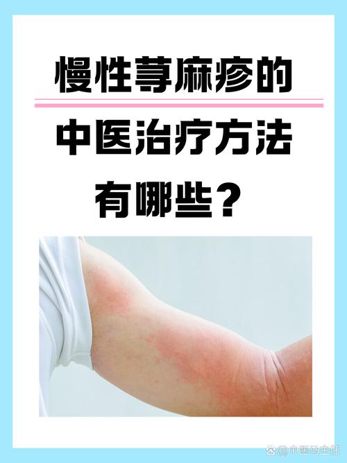 科学地治疗瘾疹 中西医齐出动