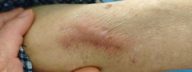 又是留置针惹的祸！这类患者必须及时拔除留置针！