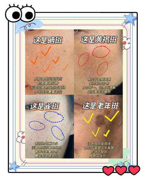 脸上如何祛斑？脸部祛斑方法值得一看
