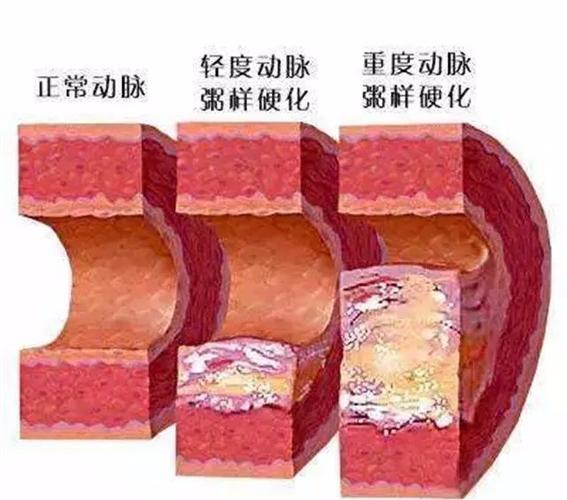 腹主动脉粥样硬化性改变