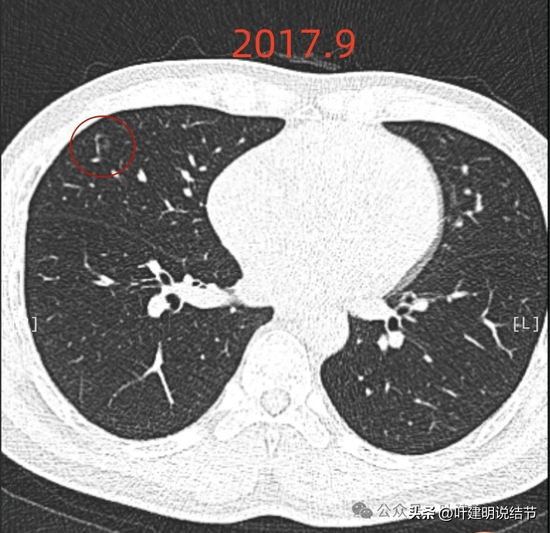 问诊分析：来看看随访7年了的肺磨玻璃结节的演变过程