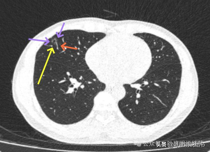 问诊分析：来看看随访7年了的肺磨玻璃结节的演变过程