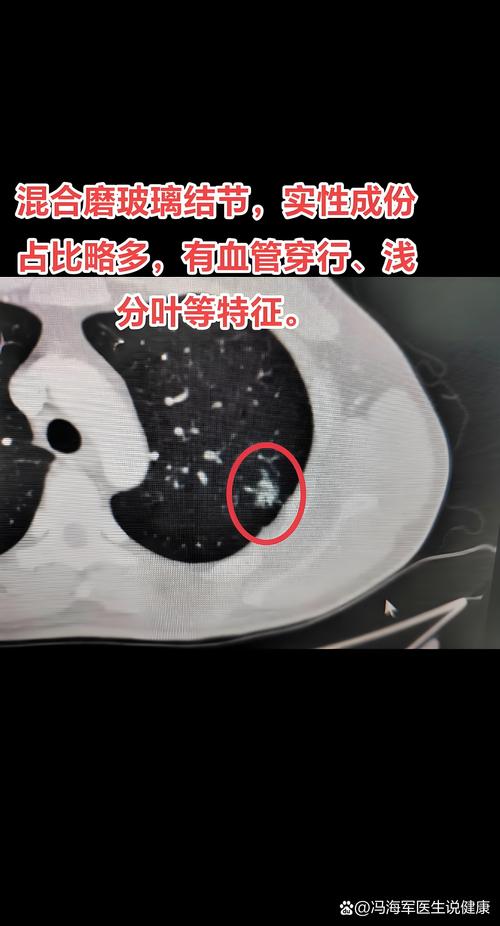 问诊分析：来看看随访7年了的肺磨玻璃结节的演变过程
