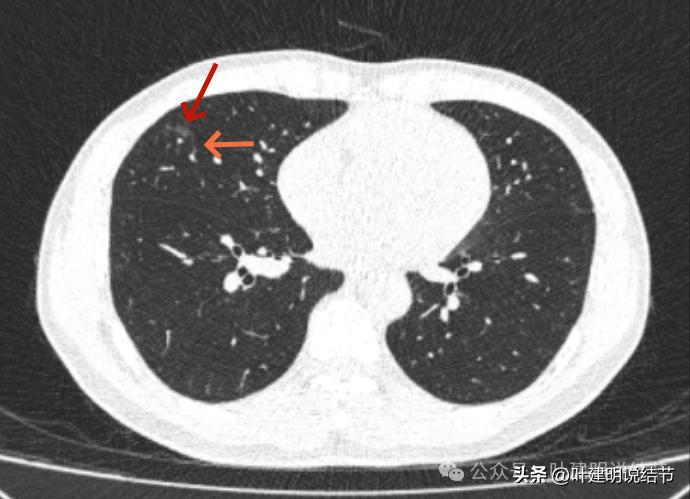 问诊分析：来看看随访7年了的肺磨玻璃结节的演变过程