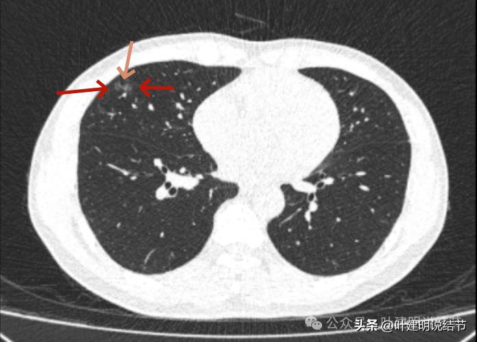 问诊分析：来看看随访7年了的肺磨玻璃结节的演变过程
