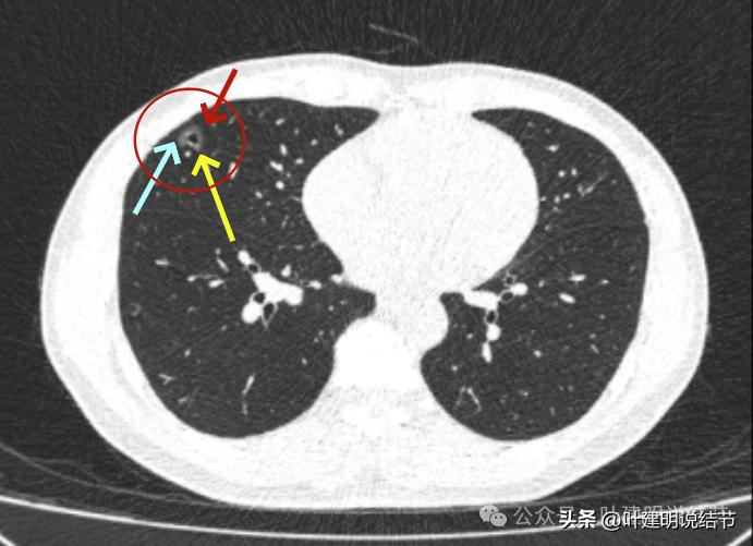 问诊分析：来看看随访7年了的肺磨玻璃结节的演变过程