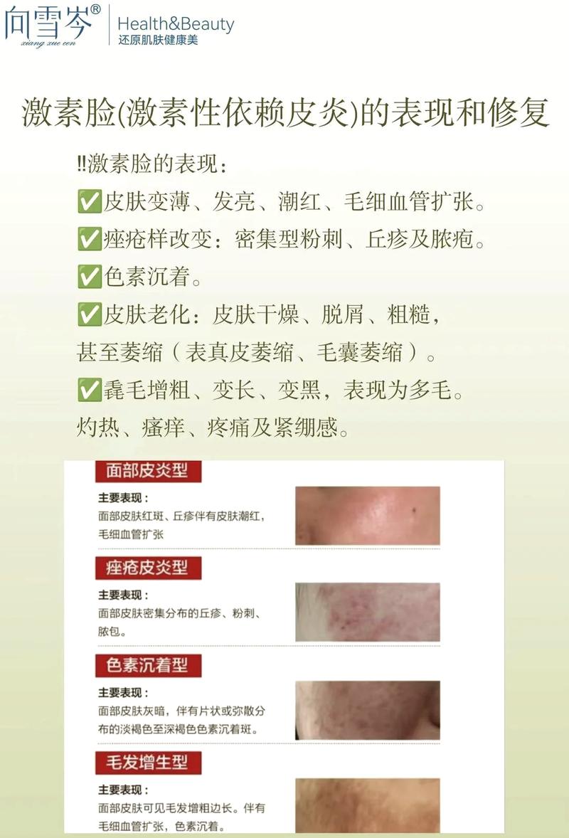 面部激素依赖性皮炎临床分析