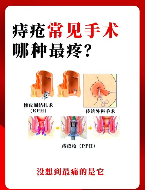痔疮手术也能“无痛变轻松”？揭秘痔疮治疗的奇妙之旅
