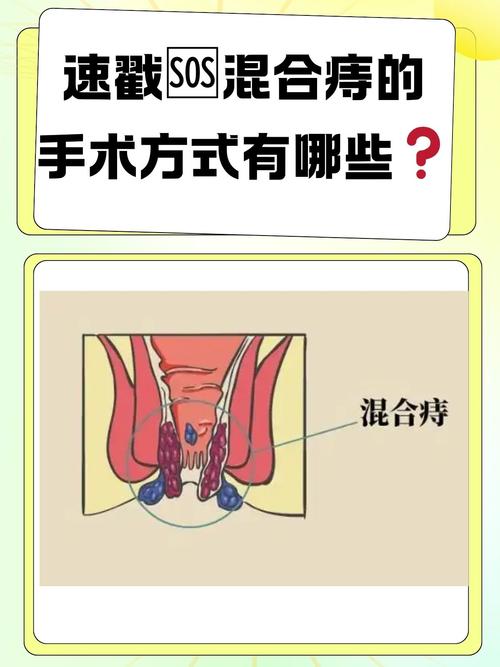 痔疮手术哪种最彻底？哪种最不疼？一文告诉你常见痔疮手术优缺点