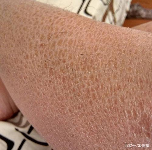 什么是先天性非大疱性鱼鳞病样红皮病？日常生活中如何预防鱼鳞病
