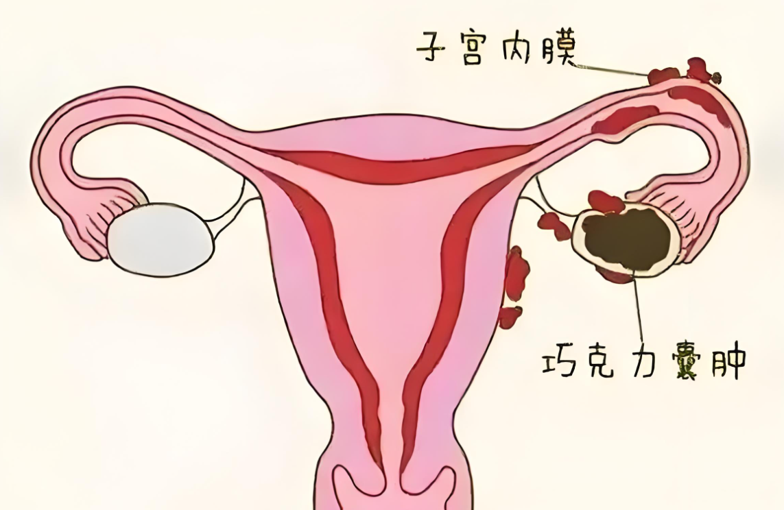 复发性子宫内膜异位症，该如何用药呢？