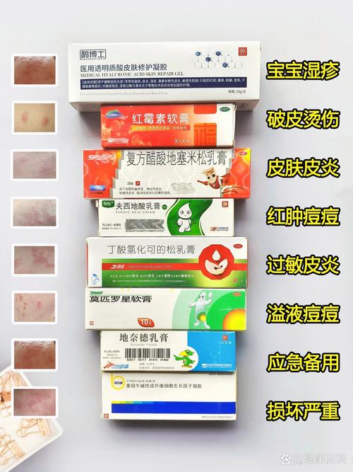 婴儿湿疹用什么药膏