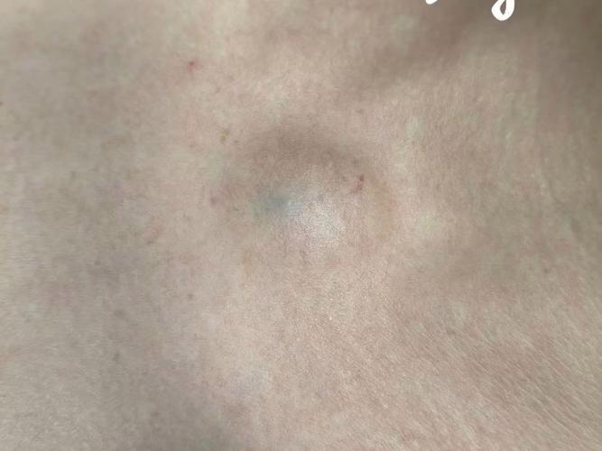 皮肤囊肿手术多久恢复?