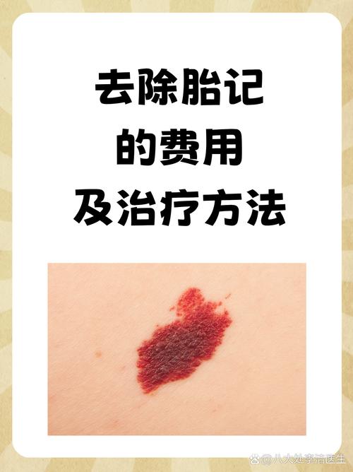 孩子身上有胎记应该怎么治疗