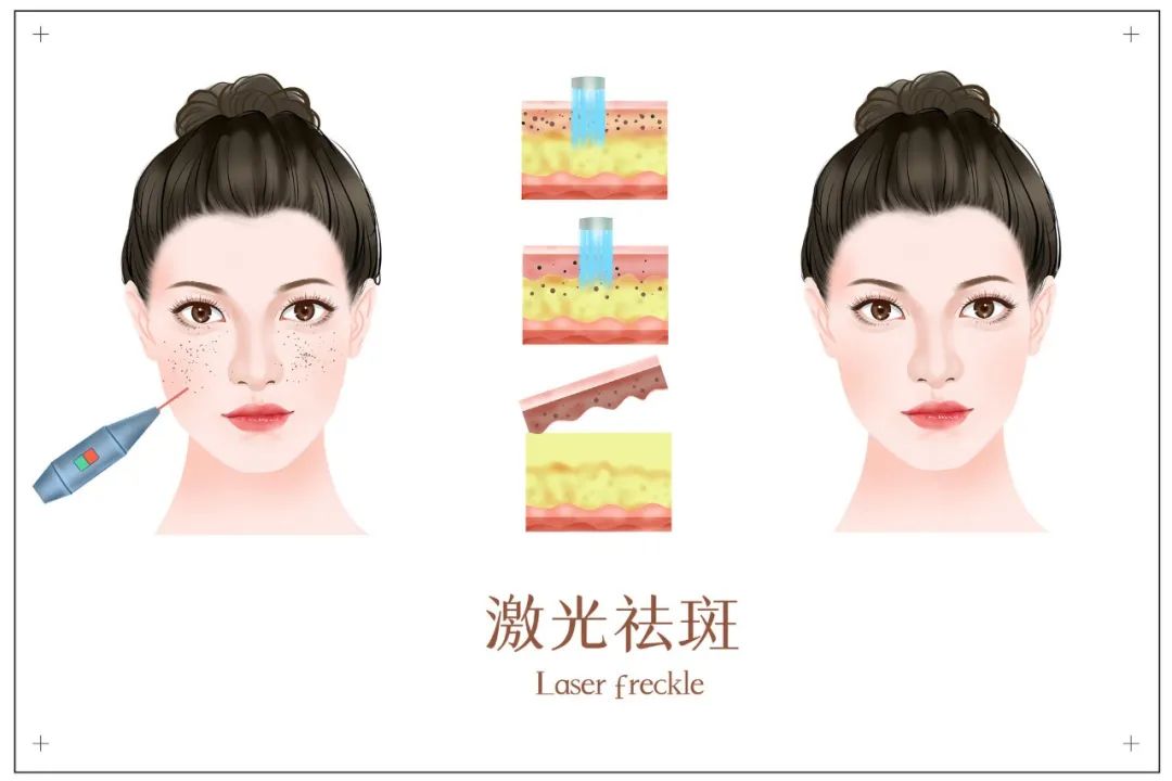 激光是色斑的最优解吗？为什么总是“春风吹又生”？
