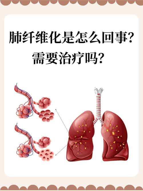 我国科学家在肺纤维化研究领域取得新突破（新知）