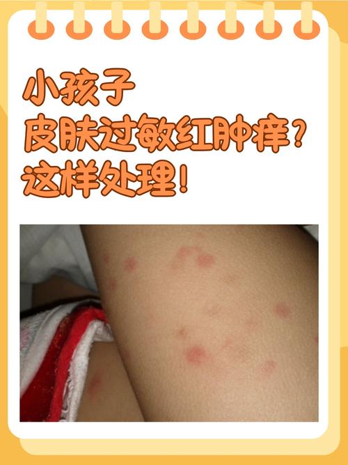 孩子过敏，有哪些特殊表现？别不放心上！一定要留意！