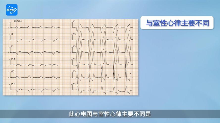 高血钾致窦室传导的心电图表现及特征
