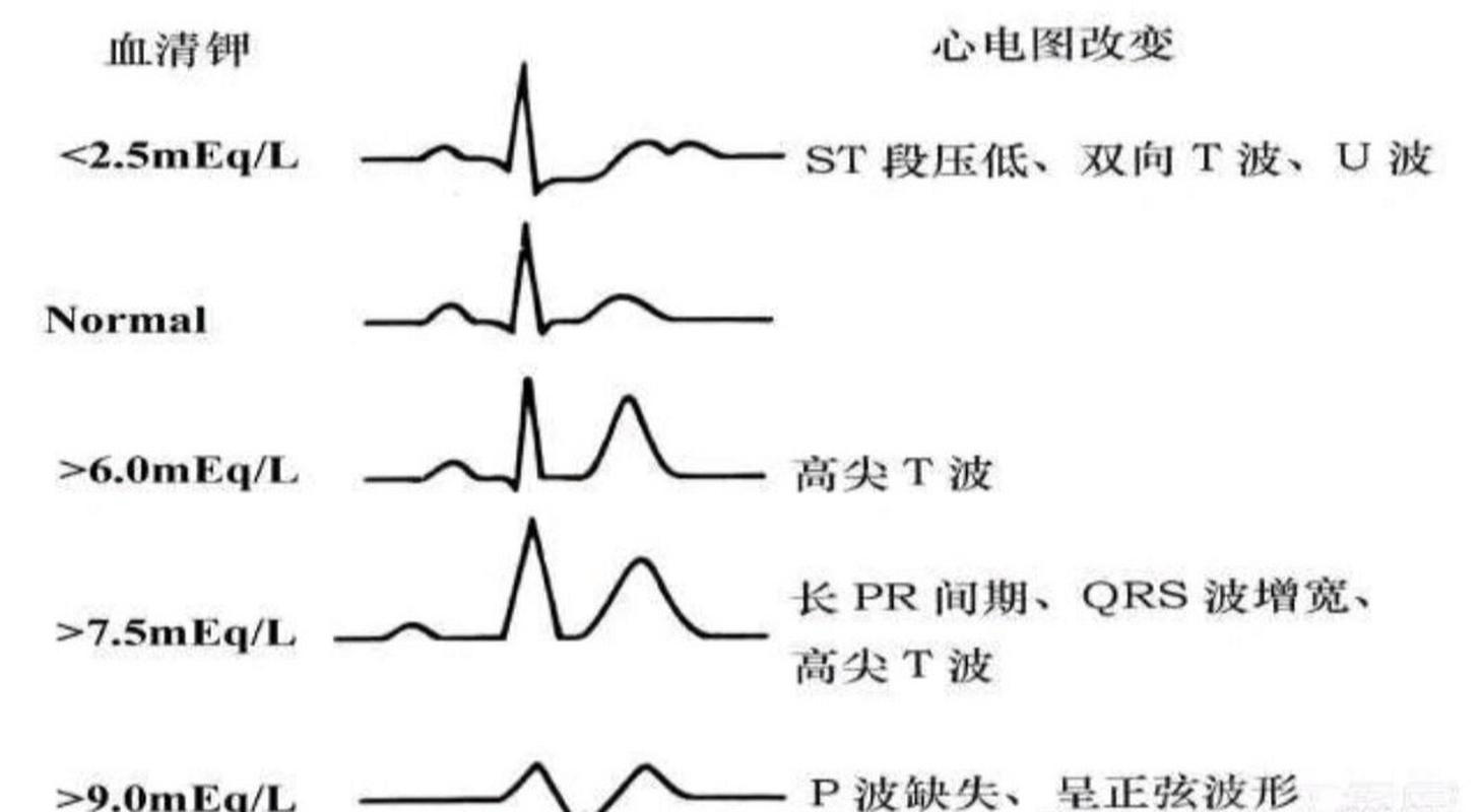 高血钾致窦室传导的心电图表现及特征