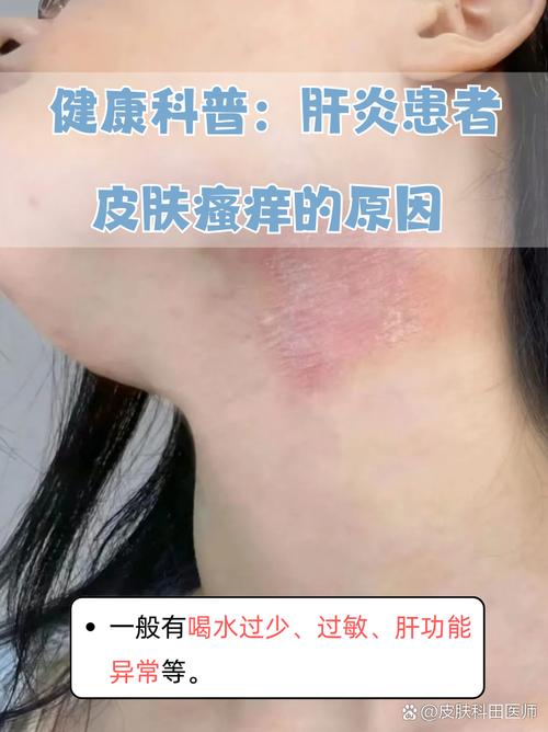 肝功能不健康的人，或会出现“2痒、3黑”，若你有，或需检查