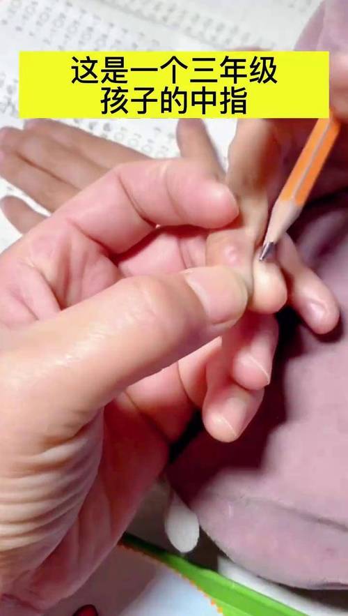 6岁女孩患多巴反应性肌张力障碍手指难抓握 作业治疗3个月为手功能赋能